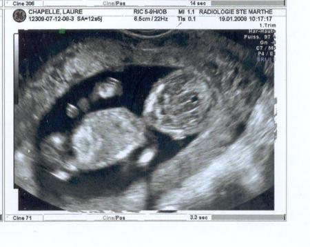 �chographie du 1er trimestre.